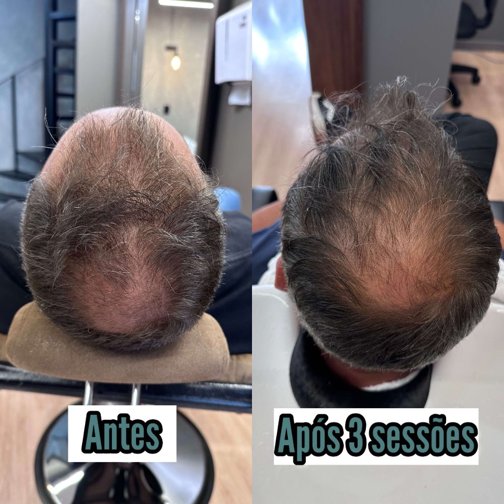 Fio Derma no couro cabeludo: antes e após 3 sessões