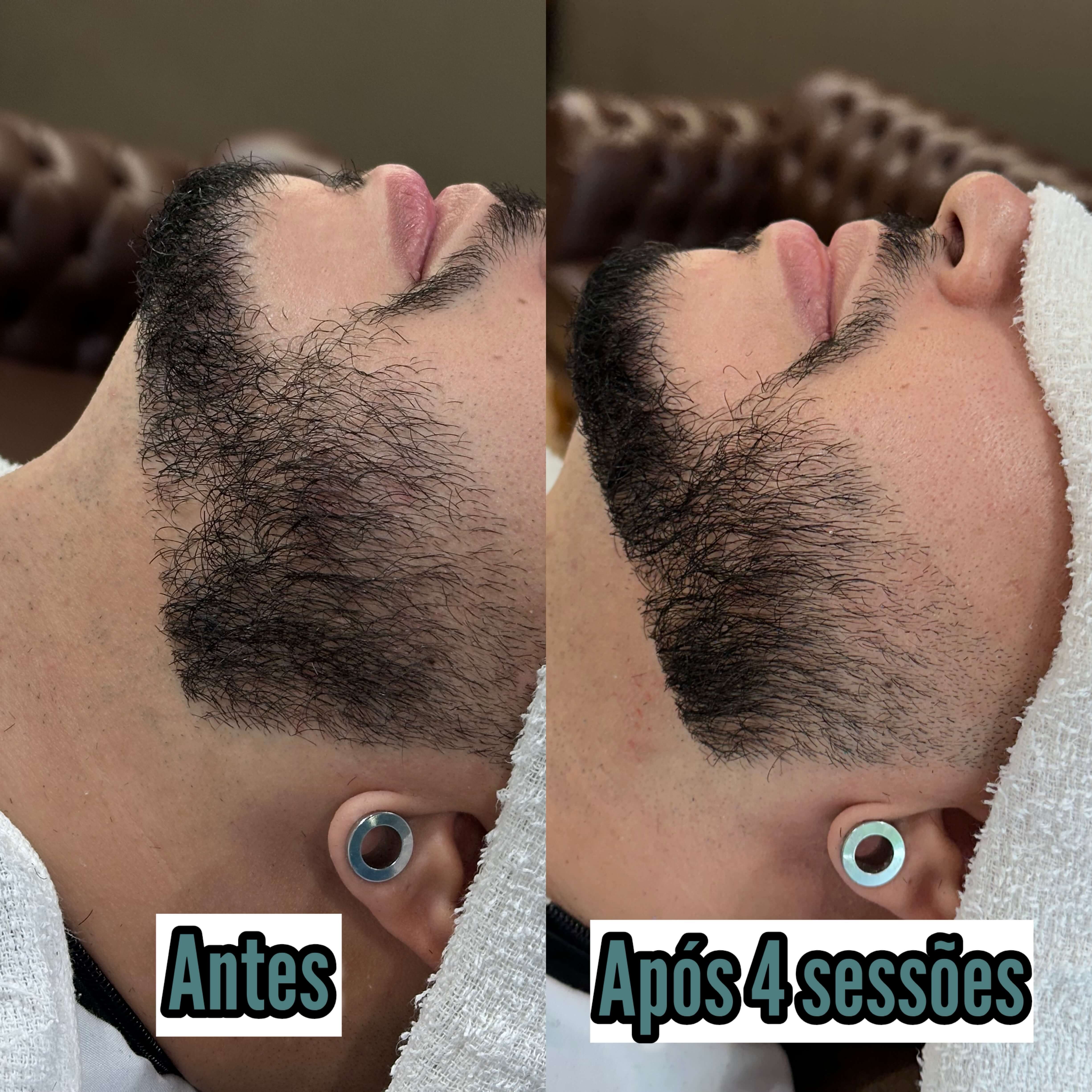 Resultado da técnica Fio Derma - antes e depois