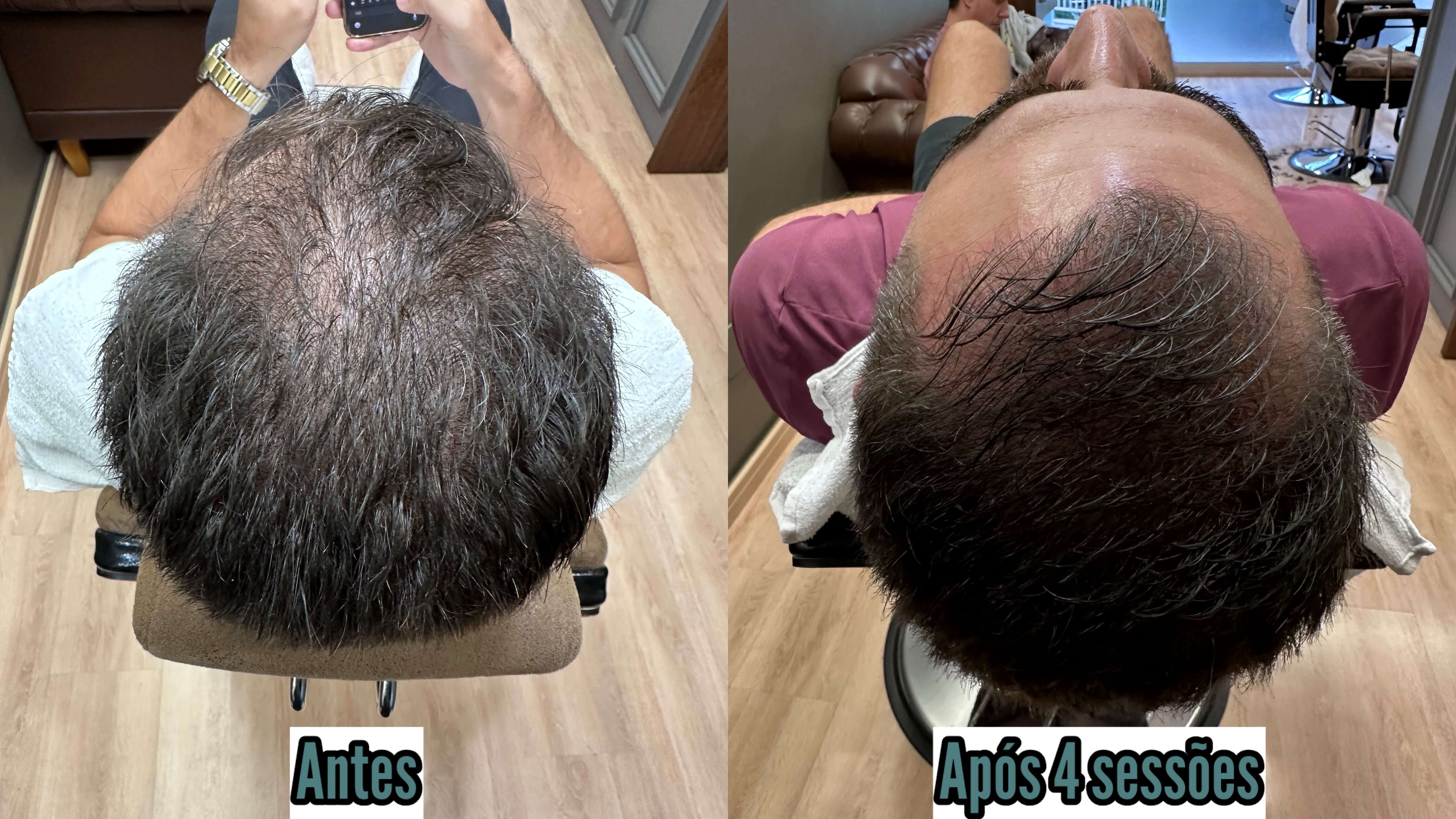 Resultado da técnica Fio Derma - antes e depois