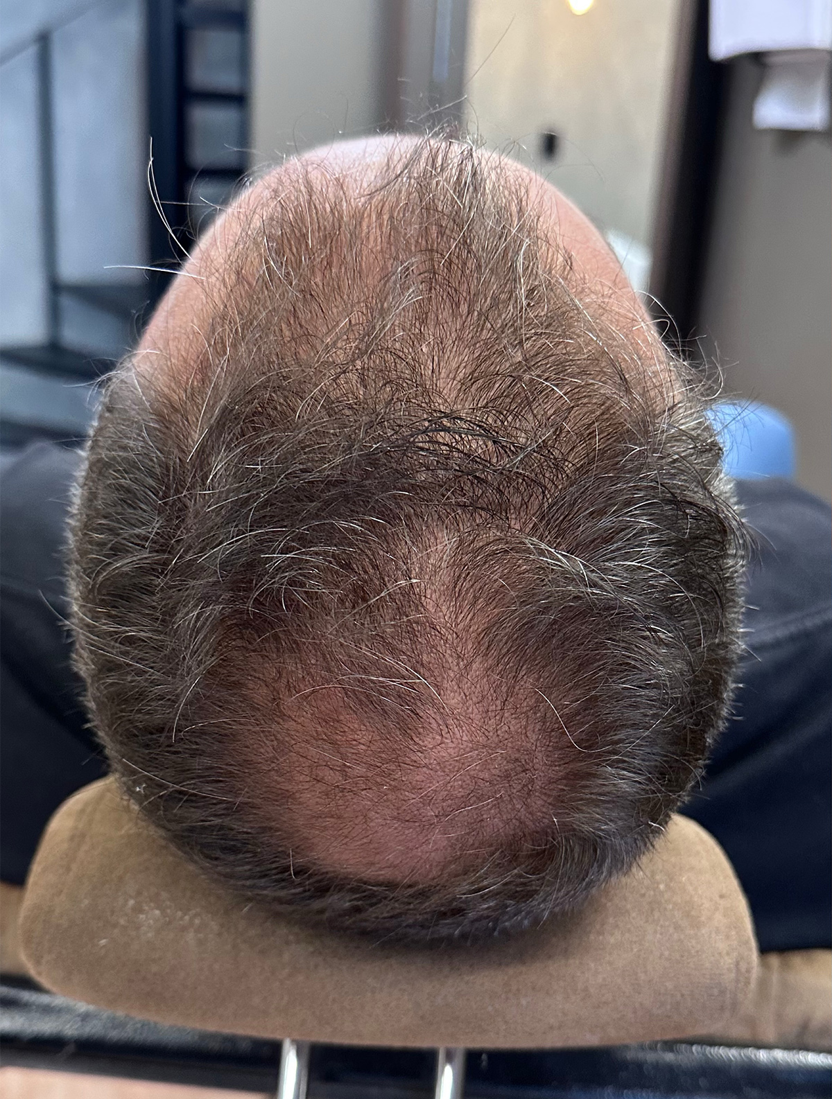 Fio Derma Depois