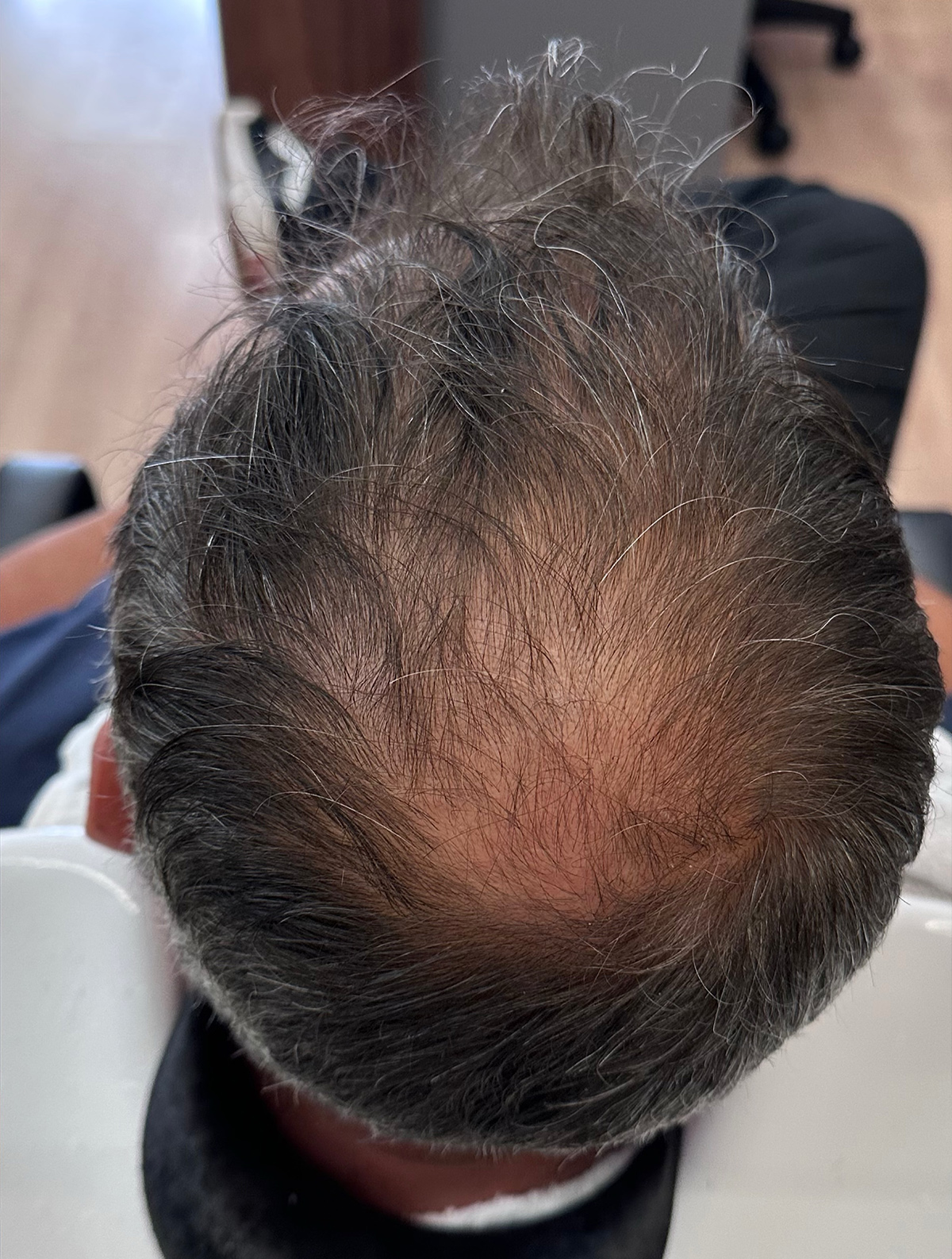 Fio Derma Antes